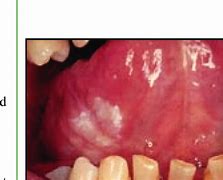 Image result for Squamous Cell Papilloma On Tongue
