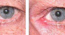 Image result for Basal Cell Carcinoma On Eyelid