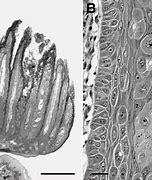 Image result for Exophytic Papilloma
