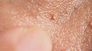 Image result for Face Warts