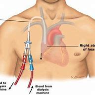 Image result for Blood Draw From PICC Line