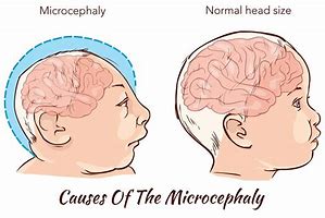 Image result for Microcephaly Behaviors