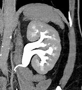 Image result for Kidney Lesion