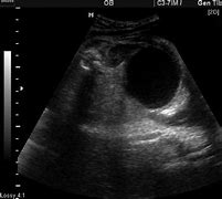 Image result for Fetal Ovarian Cyst Ultrasound