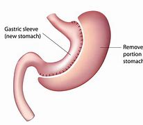 Image result for Gastric Sleeve Bariatric Surgery Procedure