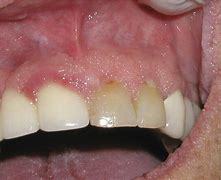 Image result for Papilloma On Buccal Gingival