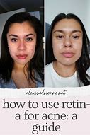 Image result for Retin a Ointment