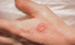 Image result for Small Red Circle Rash