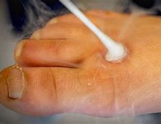 Image result for Dry-Ice Wart Removal