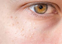 Image result for Eye Pimple