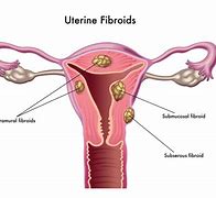 Image result for Posterior Intramural Uterine Fibroid