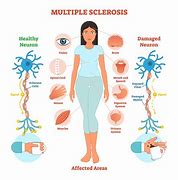 Image result for Neuroanatomy of Brain and Spinal Cord of MS Disease