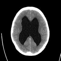 Image result for Hydrocephalus Radiology