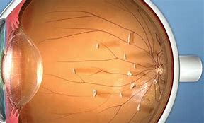 Image result for Floater Eye Examples