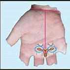 Image result for 4 Cm Cyst On Ovary