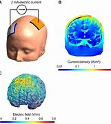 Image result for tDCS Brain Stimulation