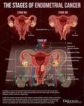 Image result for Endometrial Cancer Warning Signs