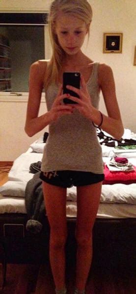 Anorexic Girls Nude
