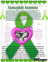 Image result for Sign of Anencephaly