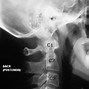 Image result for Nerves Coming Out of Cervical Spine
