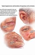 Image result for Basal Cell Skin Cancer Face
