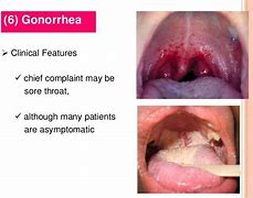 Image result for Gonorrhea Sore Throat