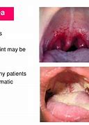 Image result for Gonorrhea of Mouth