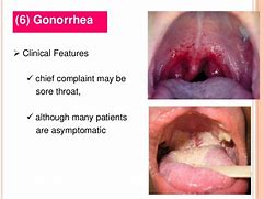 Image result for Gonorrhea On Tongue