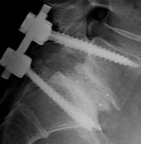 Image result for Spinal Fusion Procedure