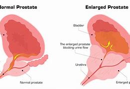 Image result for Prostatitis vs Prostatism