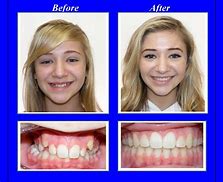 Image result for Braces On Fake Teeth