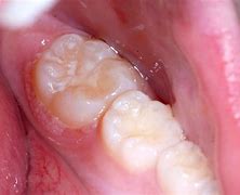 Image result for Gingival Papilloma Problems
