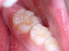 Image result for Papilloma in Throat