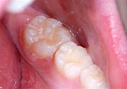 Image result for Uvula Papilloma
