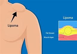 Image result for Pea Size Lump Under Skin