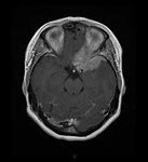 Image result for Gross Brain Image Meningioma
