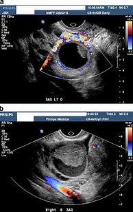 Image result for Hemorrhagic Cyst On Ultrasound