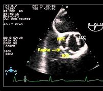 Image result for Bicuspid Aortic Valve Tee