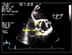 Image result for Bicuspid Aortic Valve Tee