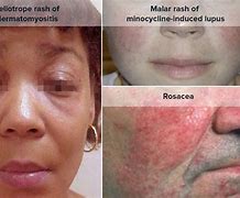 Image result for Rosacea vs Lupus