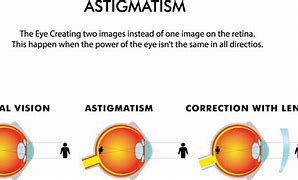 Image result for Extreme Astigmatism