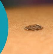 Image result for Skin Cancer On Your Scalp