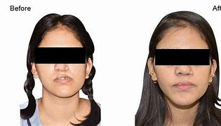 Image result for Craniofacial Surgery Before and After
