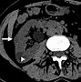 Image result for Renal Cyst Simple On CT with and without Contrast