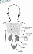 Image result for Nephrostomy Tube Infection