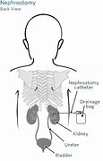 Image result for Nephrostomy Drainage Color
