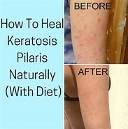 Image result for Keratosis Pilaris Elbow