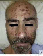 Image result for Syphilis Scars