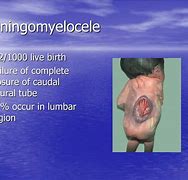 Image result for Meningomyelocele