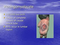 Image result for Ruptured Myelomeningocele